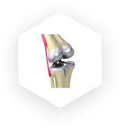 Joint replacement